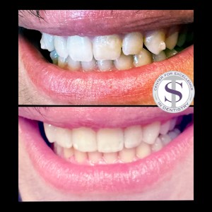 Before and after dental crowns